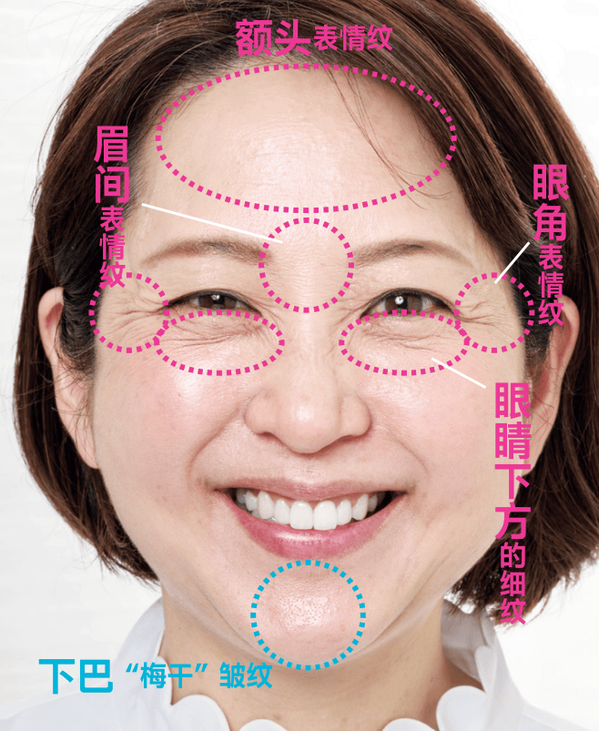 醫療美容 | 表情紋、眼周紋、法令紋，針對性改善！