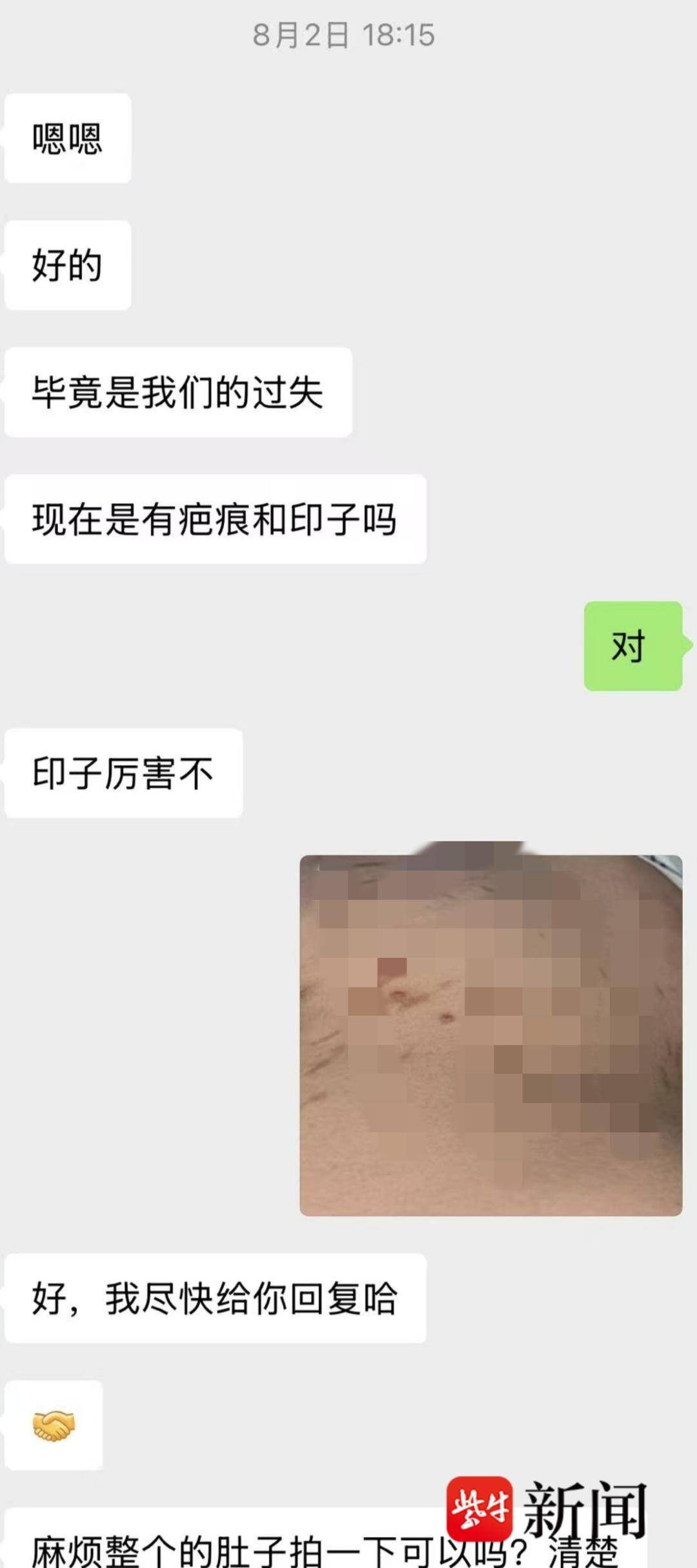 18歲女生在美容院“瘦腰”致皮膚損傷，數十條炎症印記與瘢痕九個月未消，衛健委回應：已介入處理